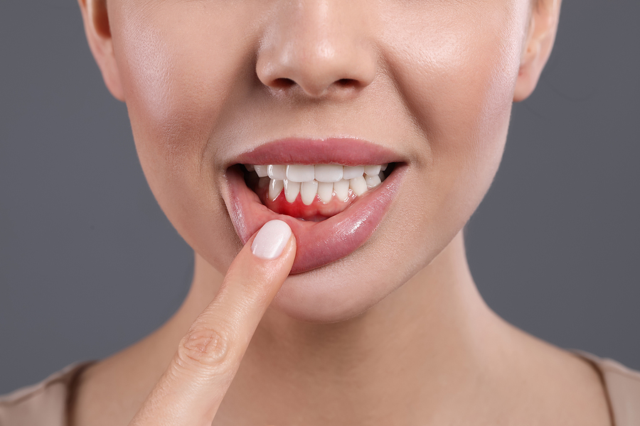 What Are the Causes of Gum Disease?